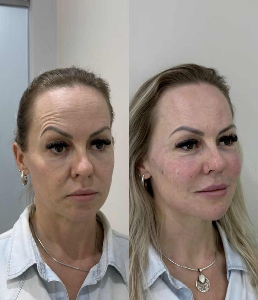 Paciente antes e depois da harmonização facial