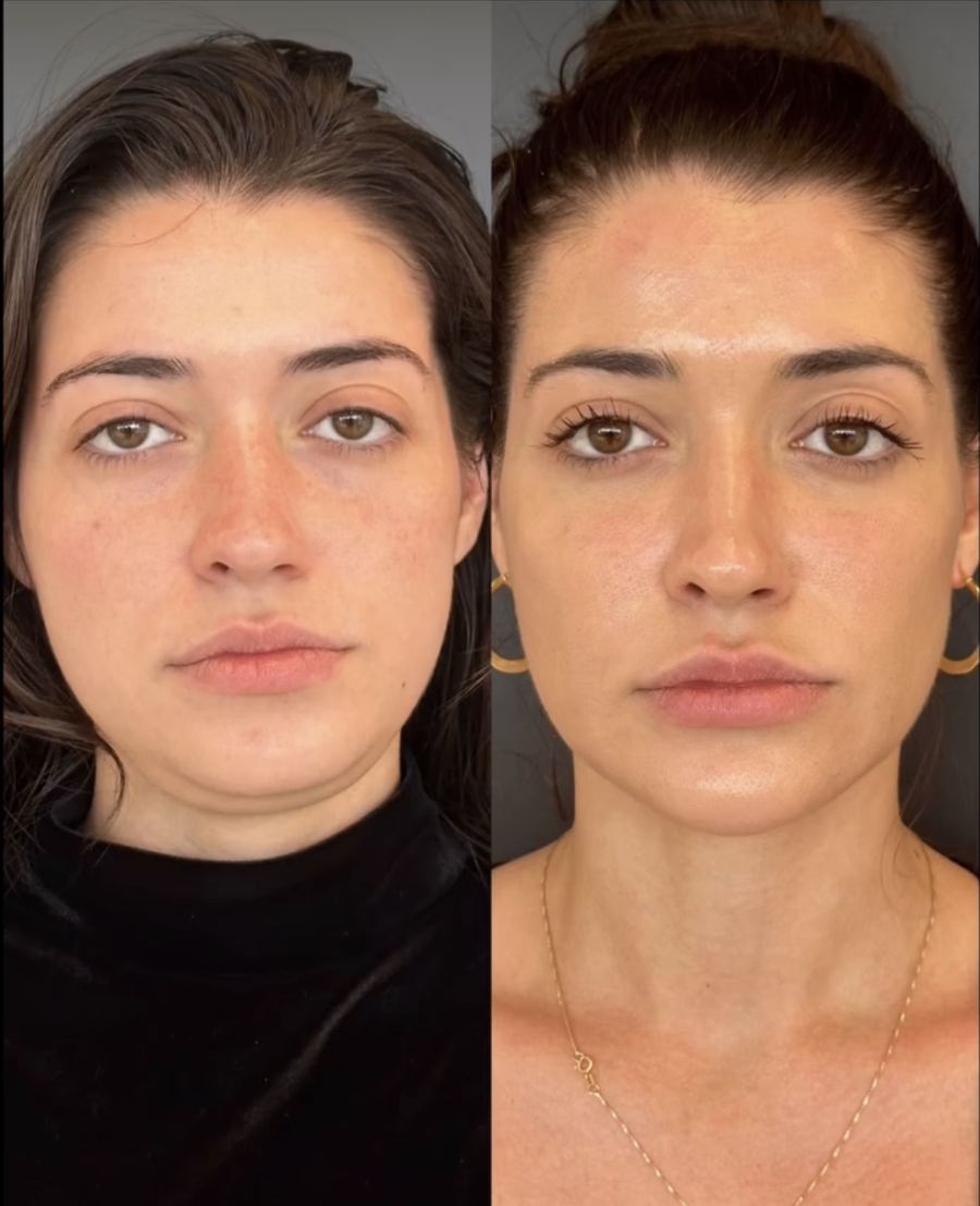 Paciente antes e depois, vista frontal