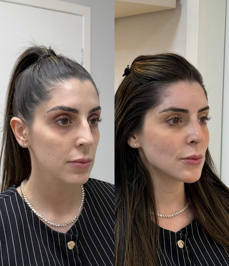 Paciente antes e depois, vista lateral
